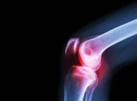 أعراض الذئبة الحمراء