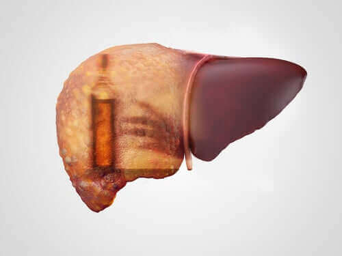التهاب الكبد الكحولي - اكتشف معنا الأعراض والمسببات والعلاجات