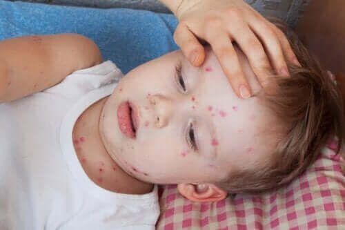 كيفية علاج حالة الشرى الجلدي لدى الأطفال