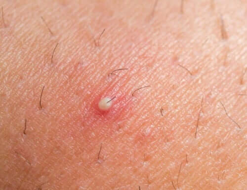 الورم الليفي الجلدي