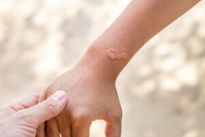 الطفيليات الخارجية - كل ما تحتاج إلى معرفته عن العث والبراغيث