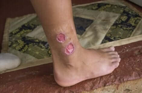 أعراض داء الليشمانيات