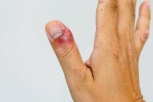 سمات وعلاجات حالة التهاب حول الظفر