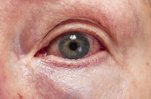 التهاب عنبية العين - كيفية تشخيص وعلاج الحالة