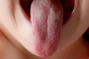 هل الحمى القرمزية معدية؟