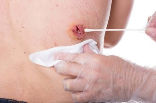 علاج الكيسات البشرانية