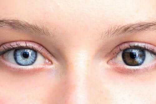 تغير لون العين - ما الذي يشير إليه؟ وما الأمراض المرتبطة بالظاهرة؟
