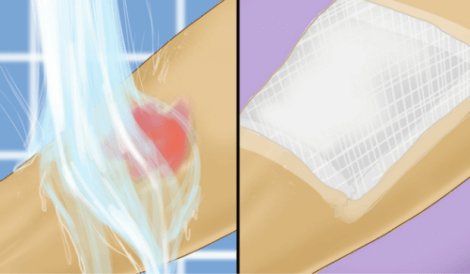 ما يجب تجنبه في حالات حروق الأطفال