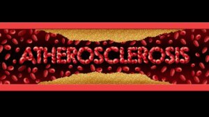 تصلب الشرايين: الأعراض والعلاج