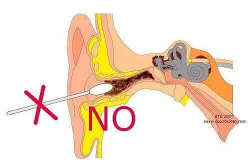 شمع الأذن علاج انسداد الأذن الشمعي بدون إضرار أذنيك لك العافية