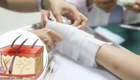 كيفية علاج حروق الأطفال