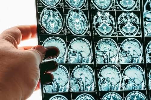 فتق الدماغ - الأعراض الشائعة، المسببات وعملية التشخيص