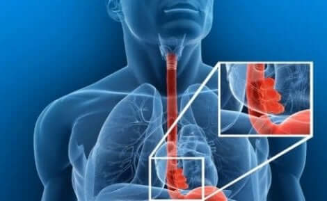 انسداد المريء