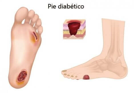 قدم السكري