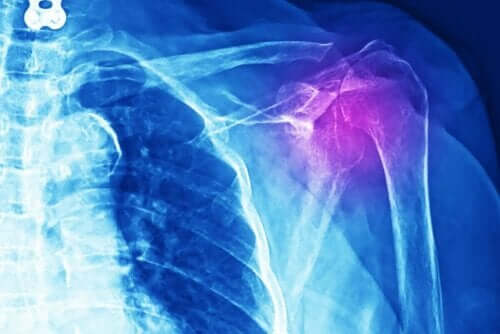 أشعة سينية لحالة التهاب أوتار الكتف