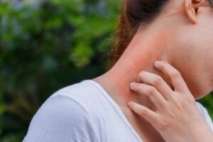 علاج التهاب الجلد بالكورتيكوستيرويدات (الستيرويدات القشرية)