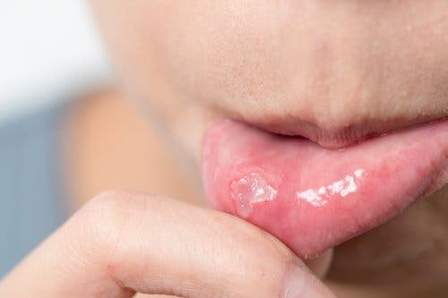 5 طرق لعلاج التهاب الفم القلاعي