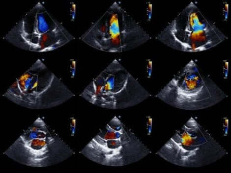 Echocardiogram