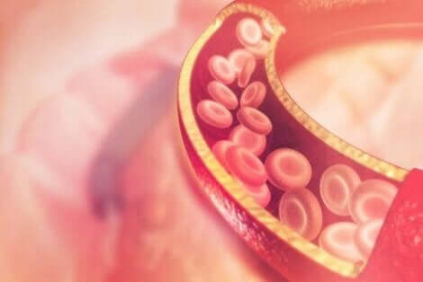 التهاب الوريد الخثاري السطحي