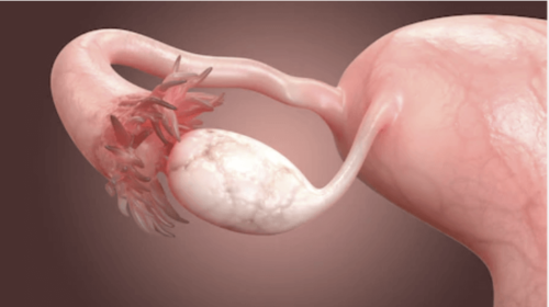 أسباب وأعراض انسداد قنوات فالوب أو ما يُعرف بقنوات الرحم عند المرأة