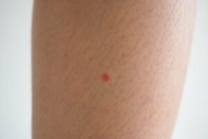 ما هي البقع الحمراء على ساقي وماذا أفعل حيالها؟