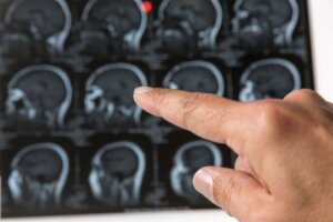 هل يمكن أن تكون كتل الرأس أورامًا مخية أو سرطانية؟