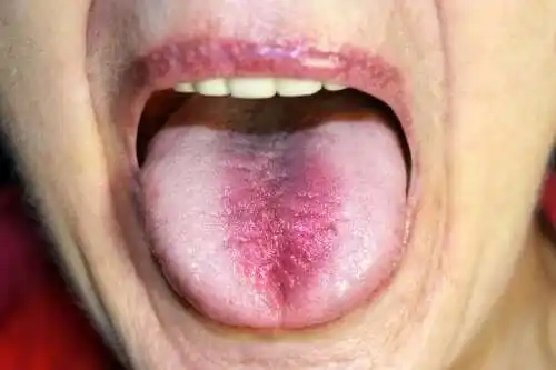 متلازمة الفم الحارق: التشخيص والعلاج