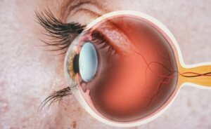 ما هو انعدام العدسة وكيف يتم علاجه؟