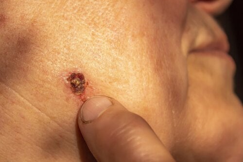 سرطان الخلايا القاعدية: سرطان الجلد الأكثر شيوعًا