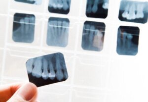 ما هو مرض تصلب الاسنان وكيف يمكن علاجه؟