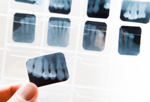 ما هو مرض تصلب الاسنان وكيف يمكن علاجه؟