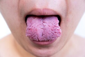 اللسان المتشقق: الأسباب والعلاج
