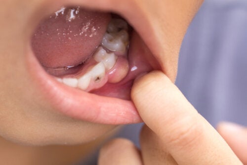 أعراض انتشار عدوى الأسنان إلى مناطق أخرى من الجسم